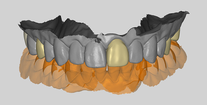 AI-Crown_Coping | Inter-Africa Dental